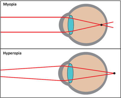 Myopia and Hyperopia - Laser Eye Surgery in Developing ... myopia hyperopia diagrams 